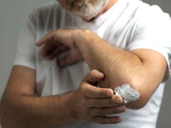 Stimmt es, dass Butter leichte Verbrennungen lindert?